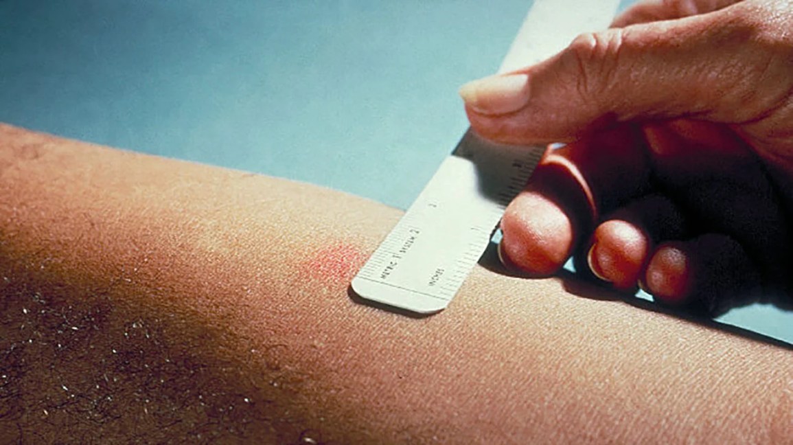 Positive-vs-Negative-TB-Test-Bump.jpg